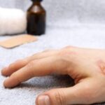 176 164229 home remedies burns 700x400