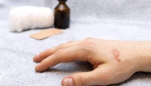 176 164229 home remedies burns 700x400