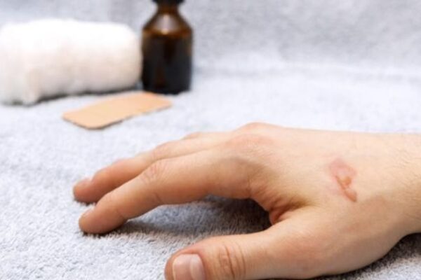 176 164229 home remedies burns 700x400